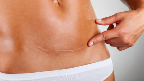 Special Considerations for Caesarean Section: Preparing for and Recovering from Belly Birth