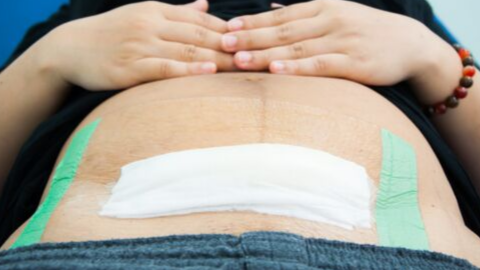 Special Considerations for Caesarean Section: Preparing for and Recovering from Belly Birth